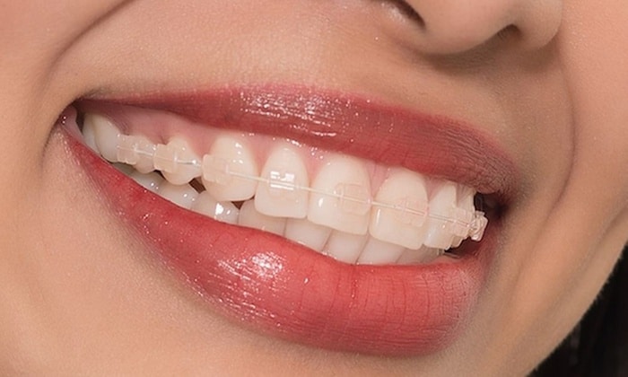 CFast cosmetic tooth alignment